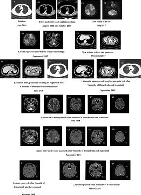 Case Report: Vemurafenib Treatment in Brain Metastases of BRAFS365L-Mutant Lung Papillary Cancer by Genetic Sequencing of Cerebrospinal Fluid Circulating Tumor DNA Detection